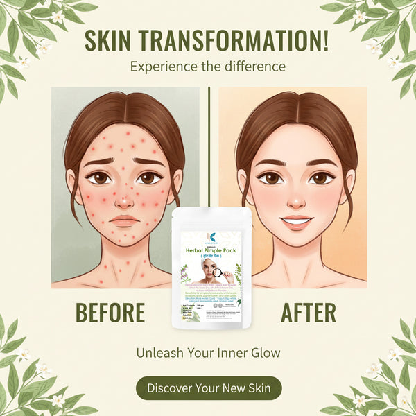 Herbal Pimple Pack Ayurvedic Care for Acne & Oily Skin Treatment Pack | Kokakoshi